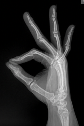 Lateral Hand Radiograph